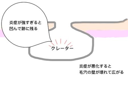 クレーター
