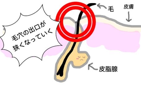 ニキビの始まり