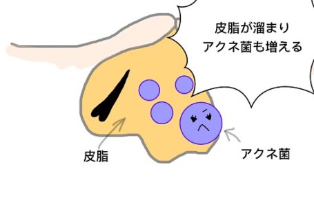 白ニキビと黒ニキビ
