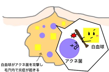 赤ニキビ