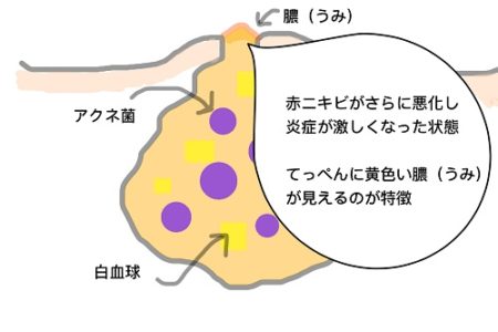 黄ニキビ